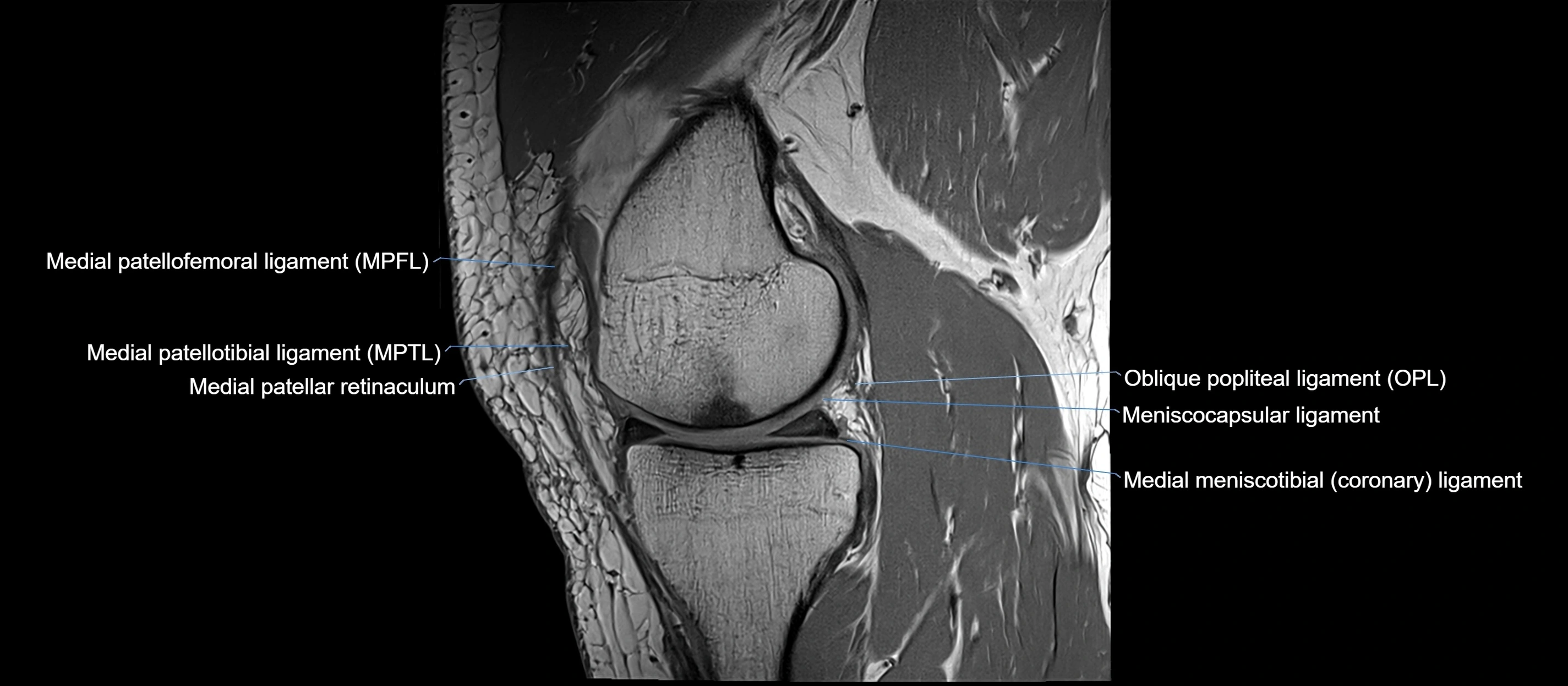 MRI sagittal  ligaments cross sectional anatomy 3T  radiology  image-img-00001-00018.webp